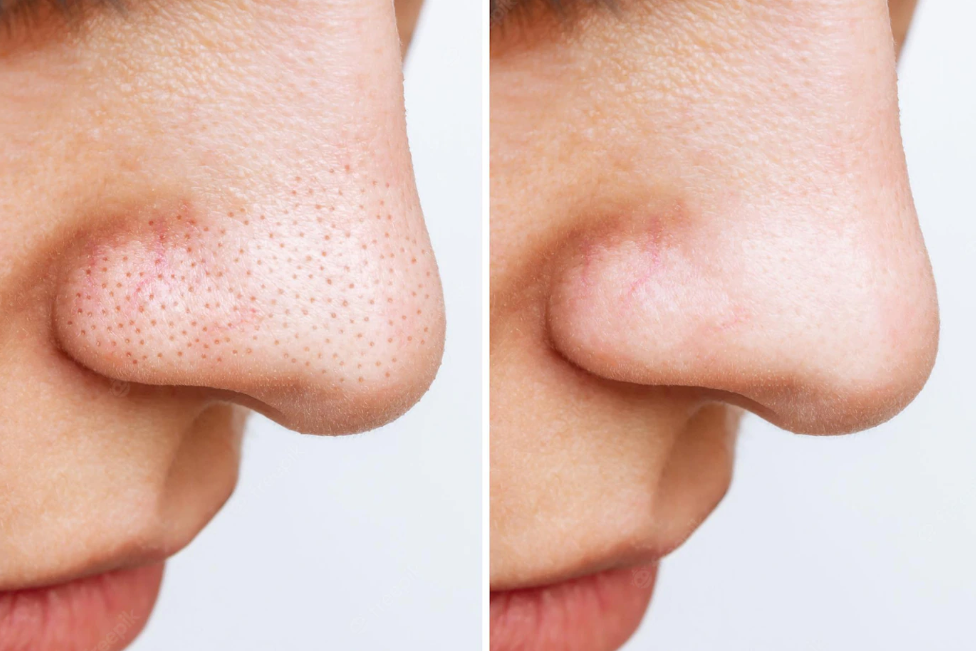 2022-05-27 11_55_38-Крупный план носа женщины с угрями или черными точками до и после пилинга кожи _